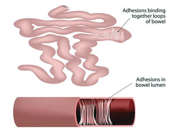 Adhesions