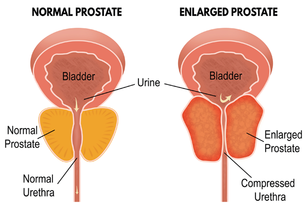 Benign prostatic hyperplasia