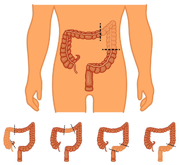 Colectomy