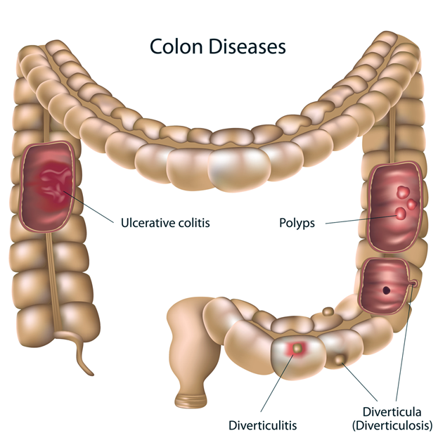 Colon diseases