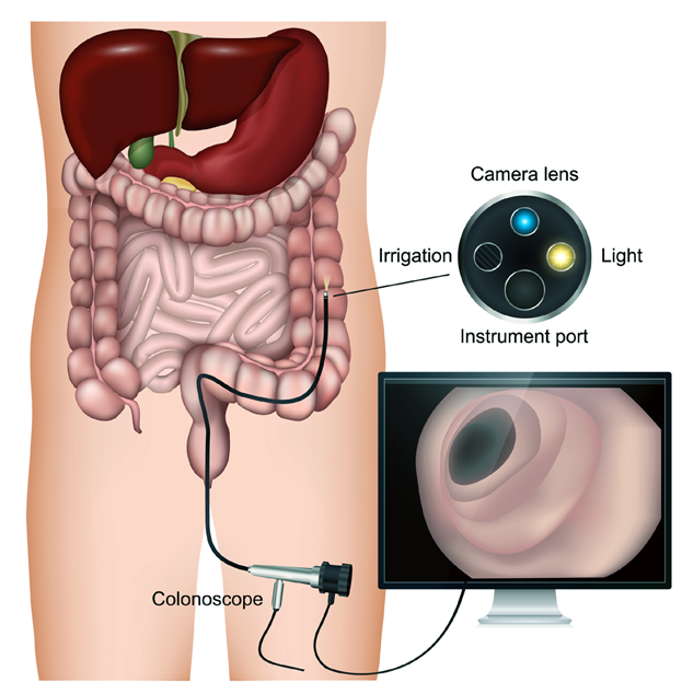Colonoscopy