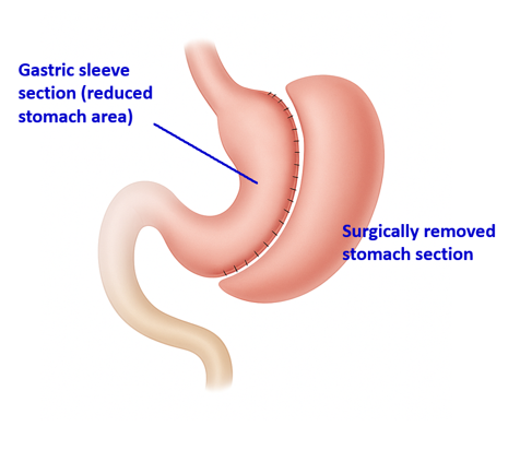 Sleeve gastrectomy
