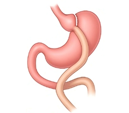 Gastric Bypass