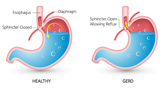 Gastroesophageal reflux