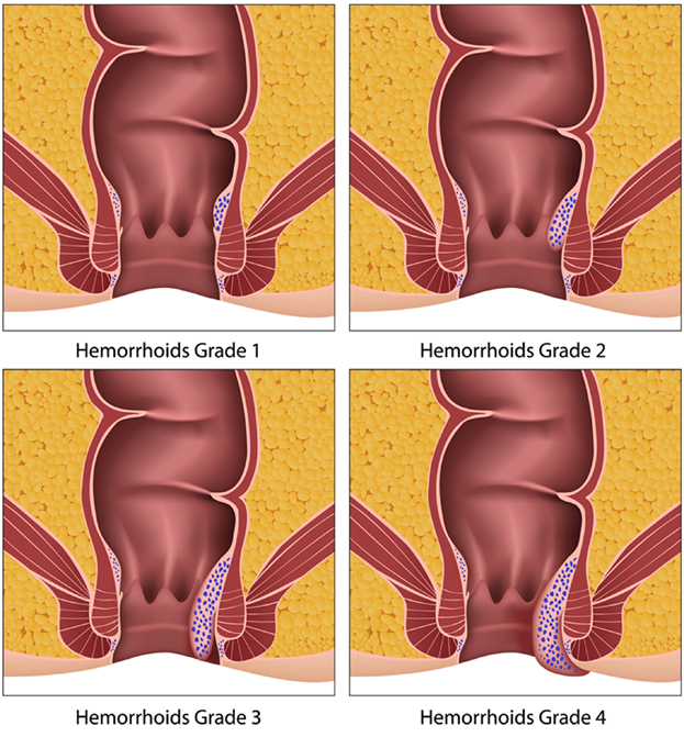Haemorrhoids