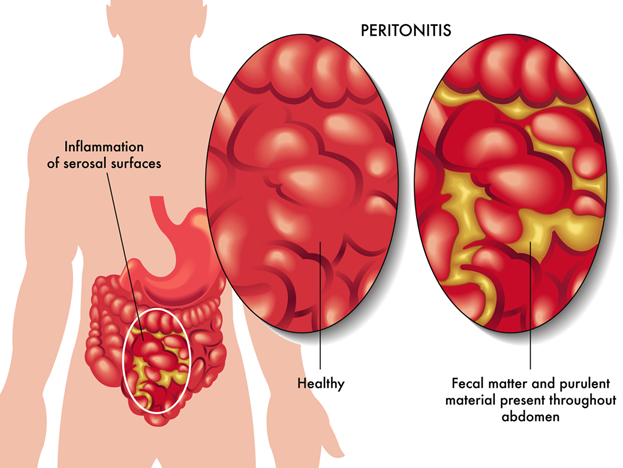 Peritonitis