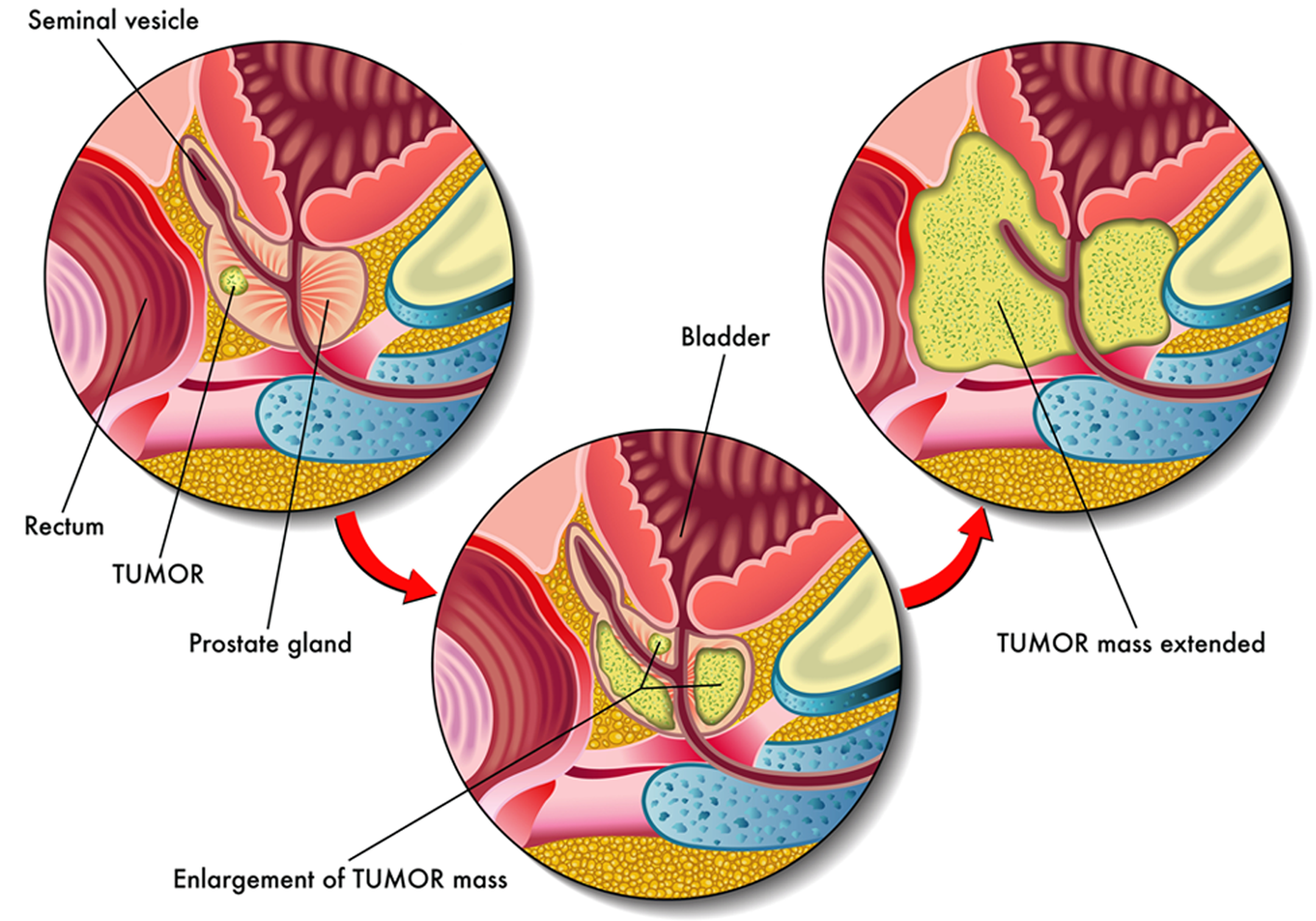 Prostate cancer