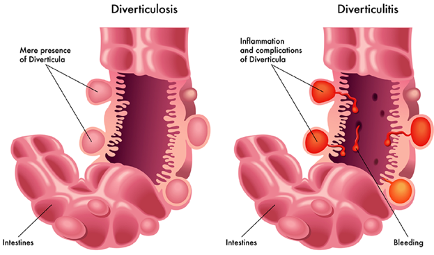 Sigmoidectomy