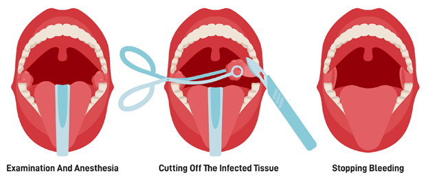 Tonsillectomy