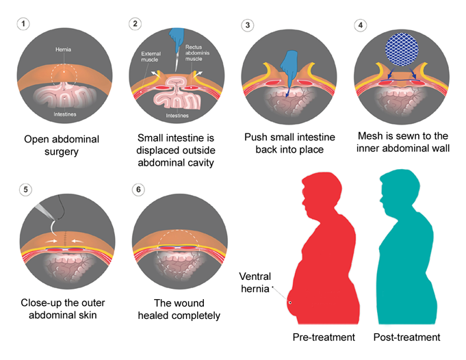 Ventral abdominal hernia